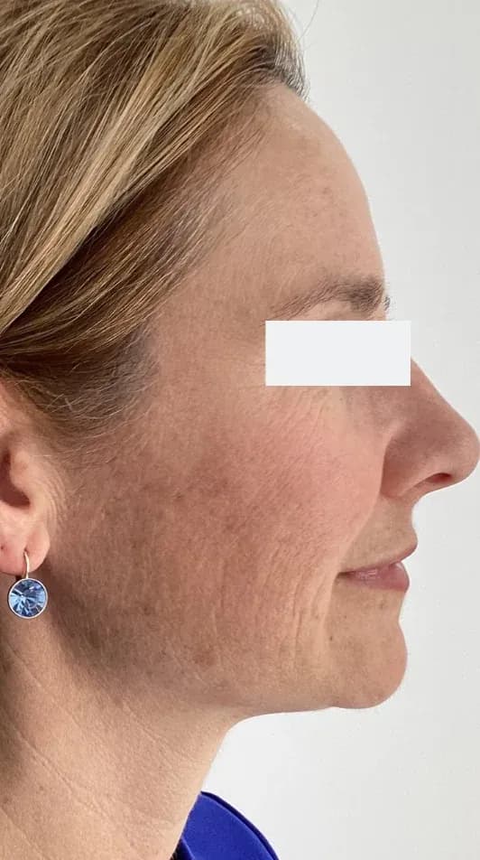 Before — HIFU Full Face & Neck — 12 weeks at Cosmo Medispa