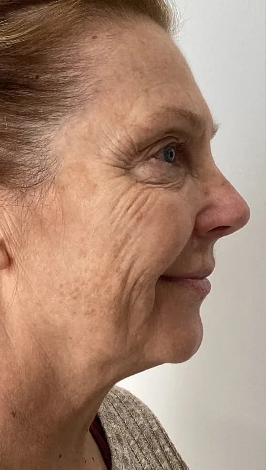 Before — HIFU Full Face & Neck — 12 weeks at Cosmo Medispa