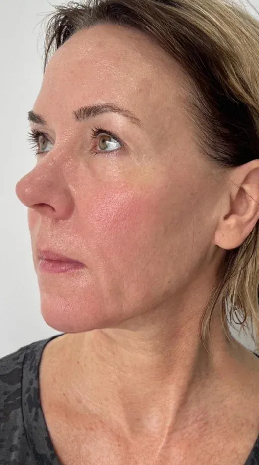 After — HIFU + RF Microneedling — 12 weeks at Cosmo Medispa