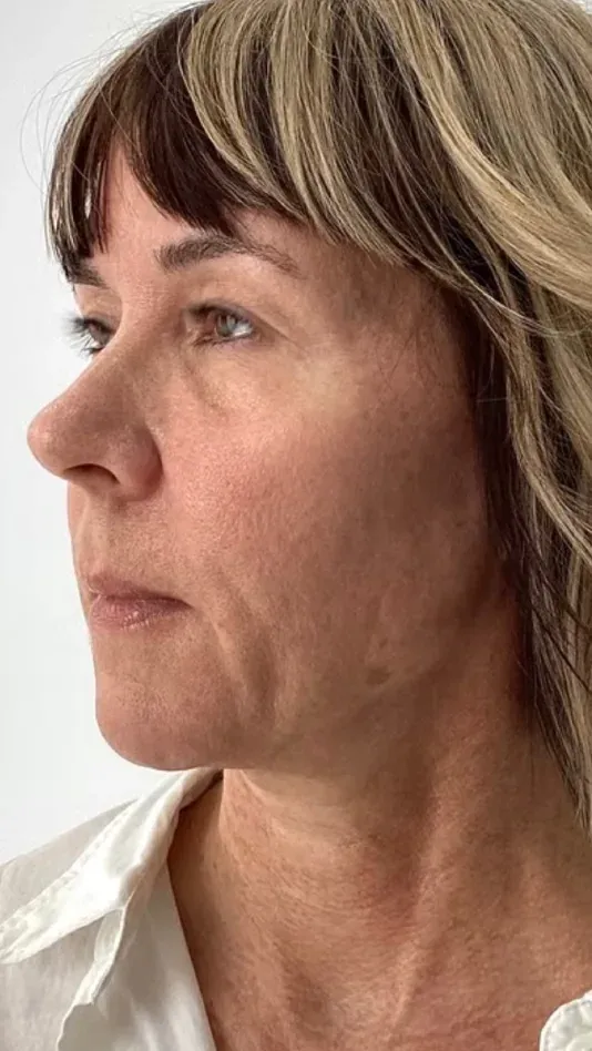 Before — HIFU + RF Microneedling — 12 weeks at Cosmo Medispa