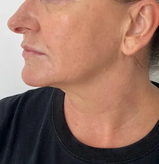 After — HIFU Full Face & Neck — 12 weeks at Cosmo Medispa