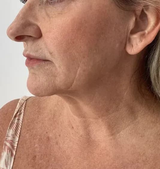 Before — HIFU Full Face & Neck — 12 weeks at Cosmo Medispa