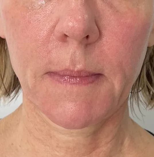 After — HIFU + RF Microneedling — 12 weeks at Cosmo Medispa