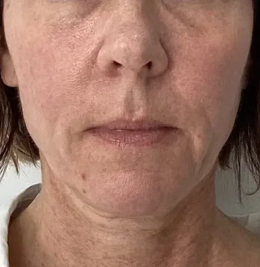 Before — HIFU + RF Microneedling — 12 weeks at Cosmo Medispa
