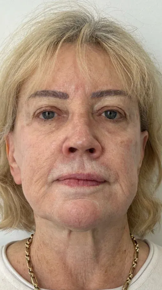 After — HIFU Full Face & Neck — 12 weeks at Cosmo Medispa