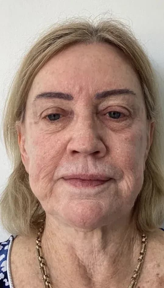 Before — HIFU Full Face & Neck — 12 weeks at Cosmo Medispa