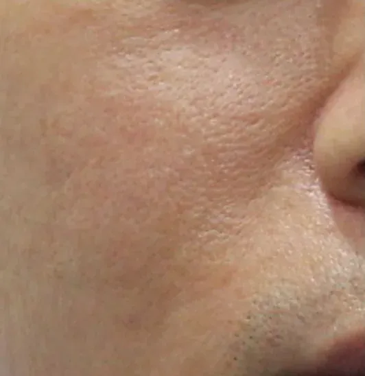 After — RF Microneedling at Cosmo Medispa