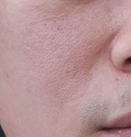 Before — RF Microneedling at Cosmo Medispa