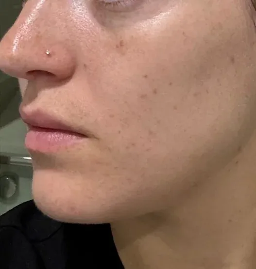 After — RF Microneedling at Cosmo Medispa