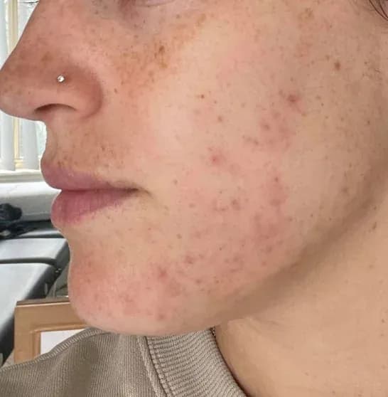Before — RF Microneedling at Cosmo Medispa