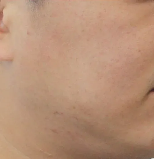 After — RF Microneedling at Cosmo Medispa