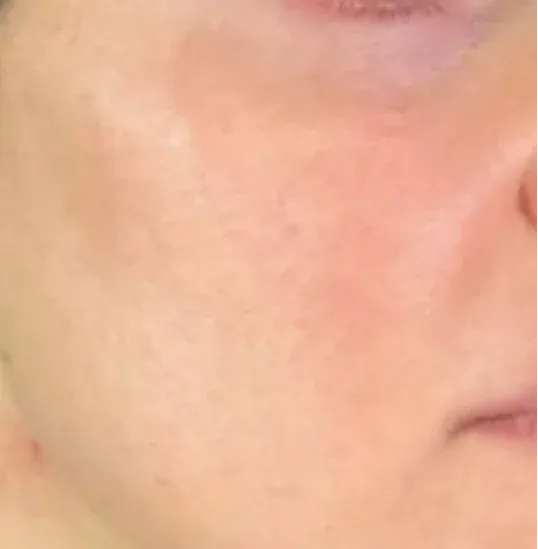 After — RF Microneedling + Exosomes at Cosmo Medispa