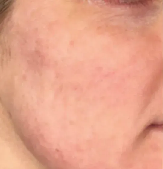 Before — RF Microneedling + Exosomes at Cosmo Medispa