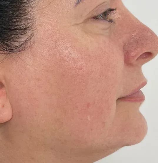 After — RF Microneedling + Exosomes at Cosmo Medispa