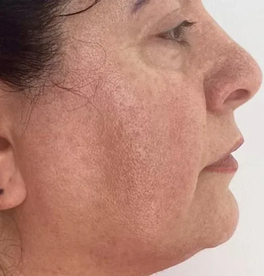 Before — RF Microneedling + Exosomes at Cosmo Medispa