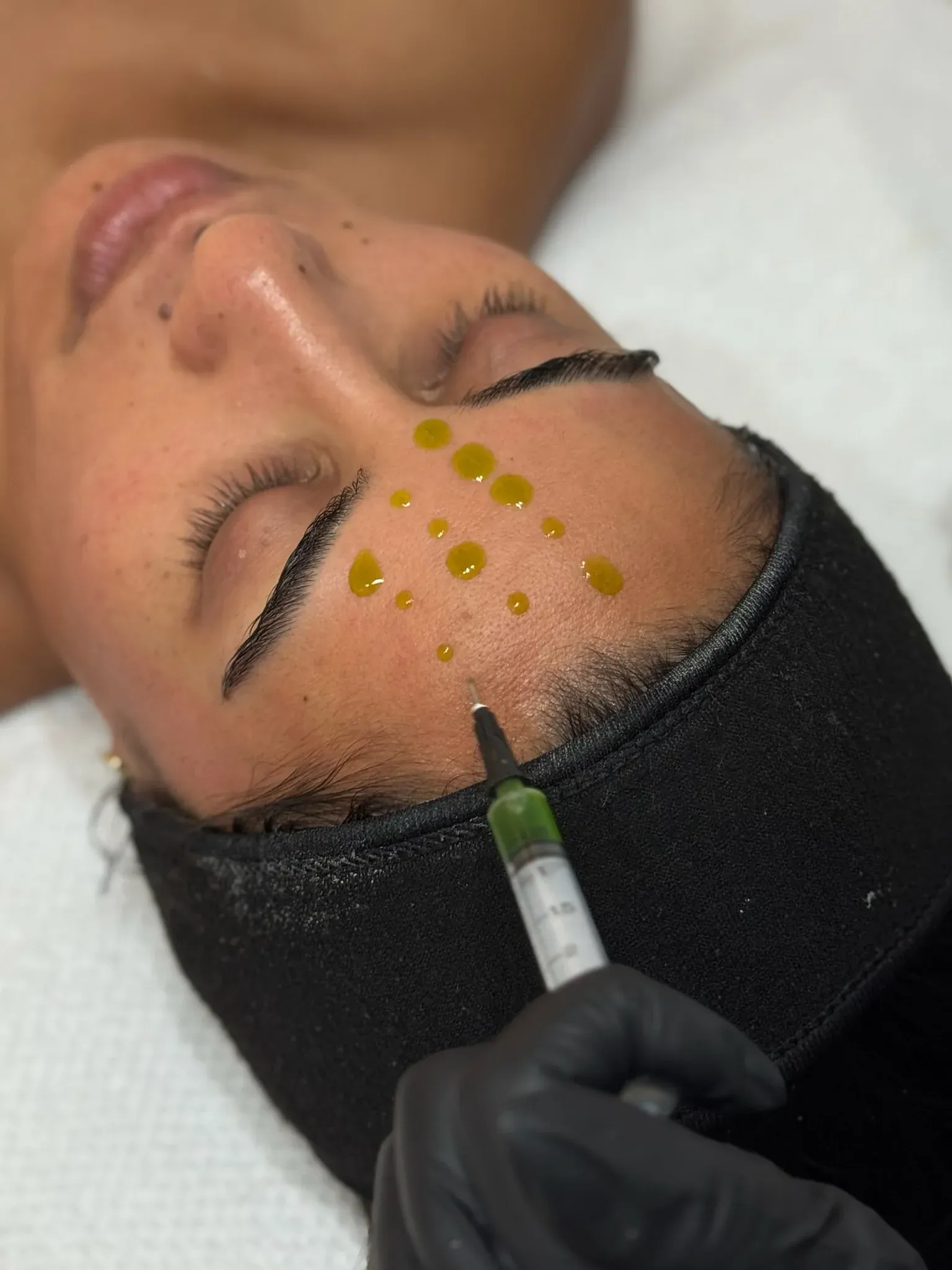 BIOREPEELCL3® Chemical Peel