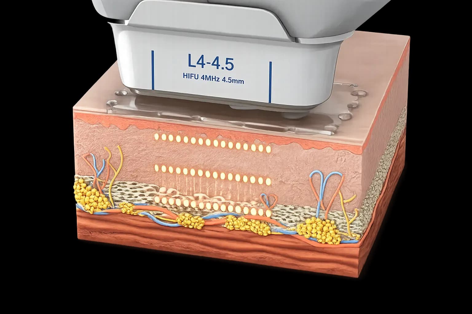 Focus Dual® HIFU Non-Surgical Facelift & Body Contouring — precision treatment