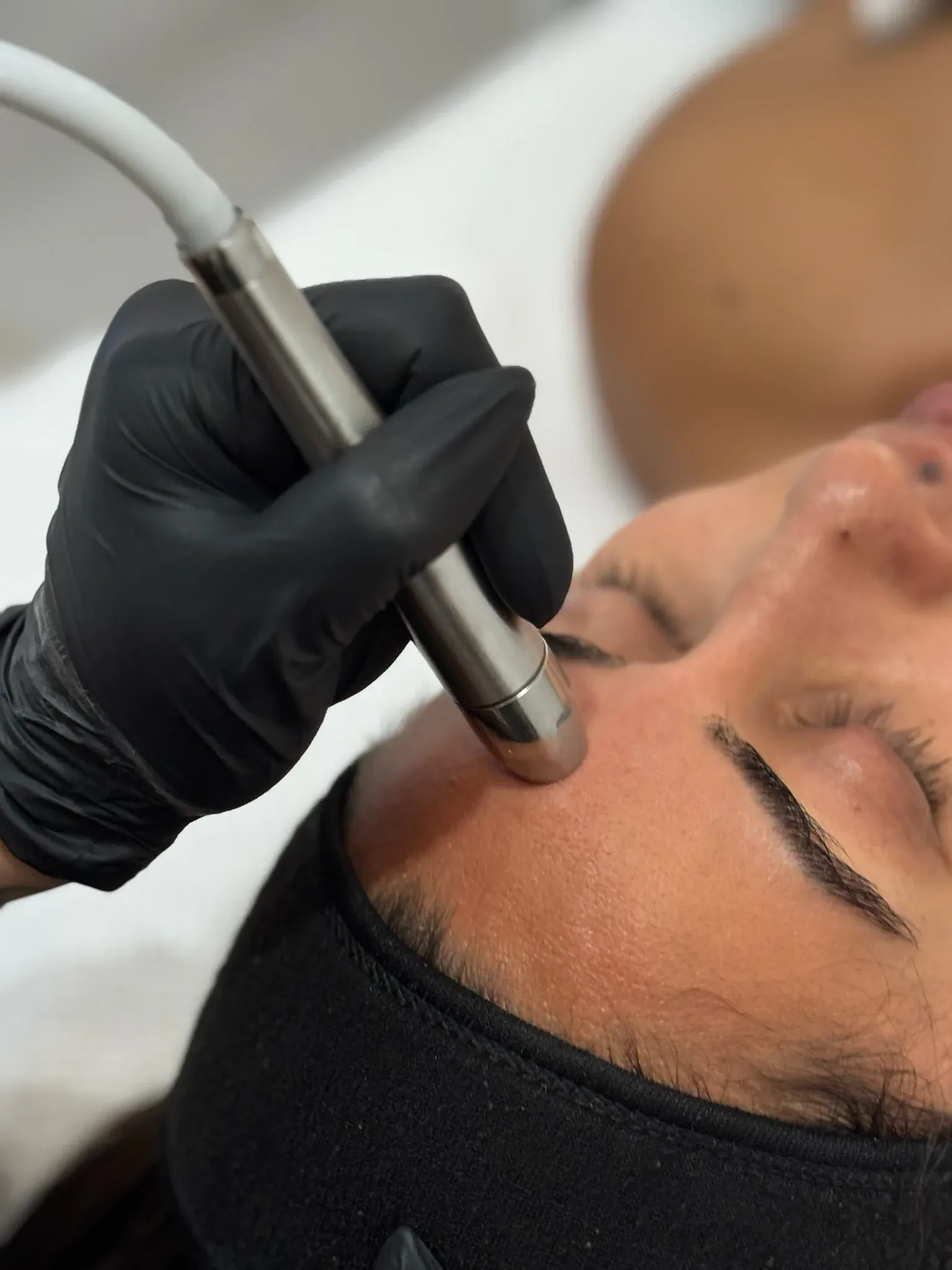 Microdermabrasion