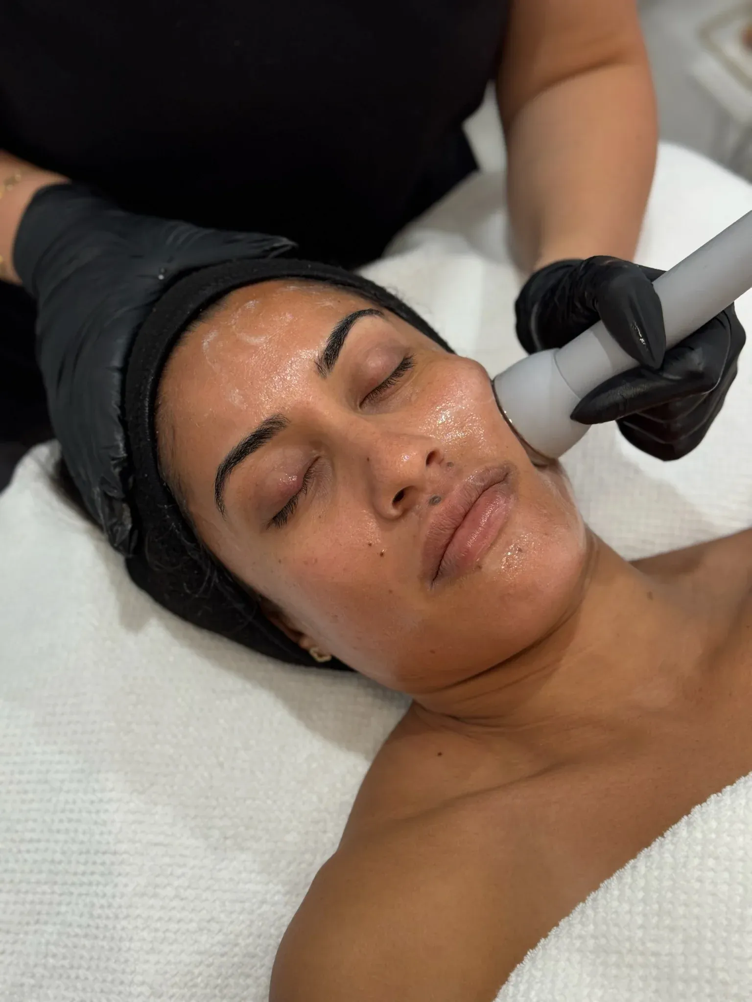 Microdermabrasion
