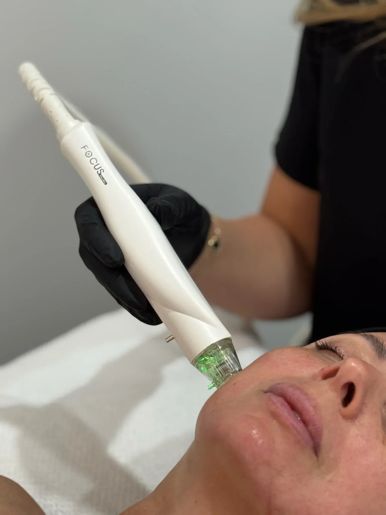RF Microneedling