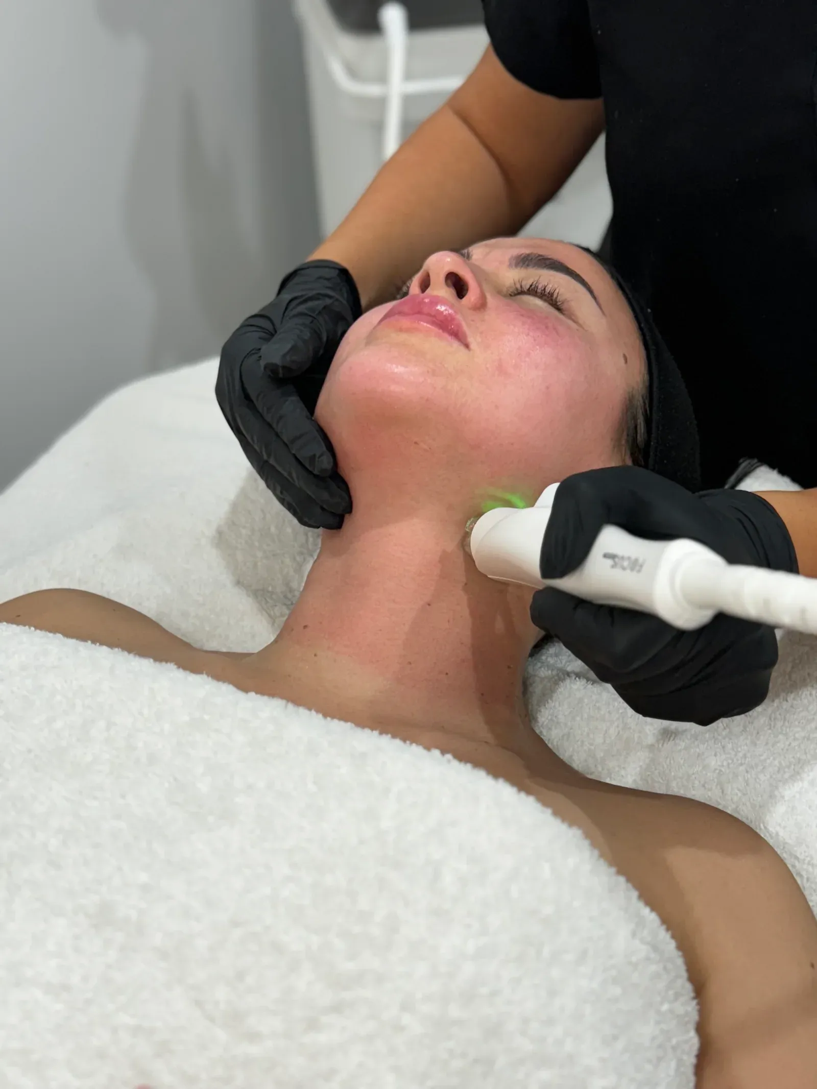 RF Microneedling