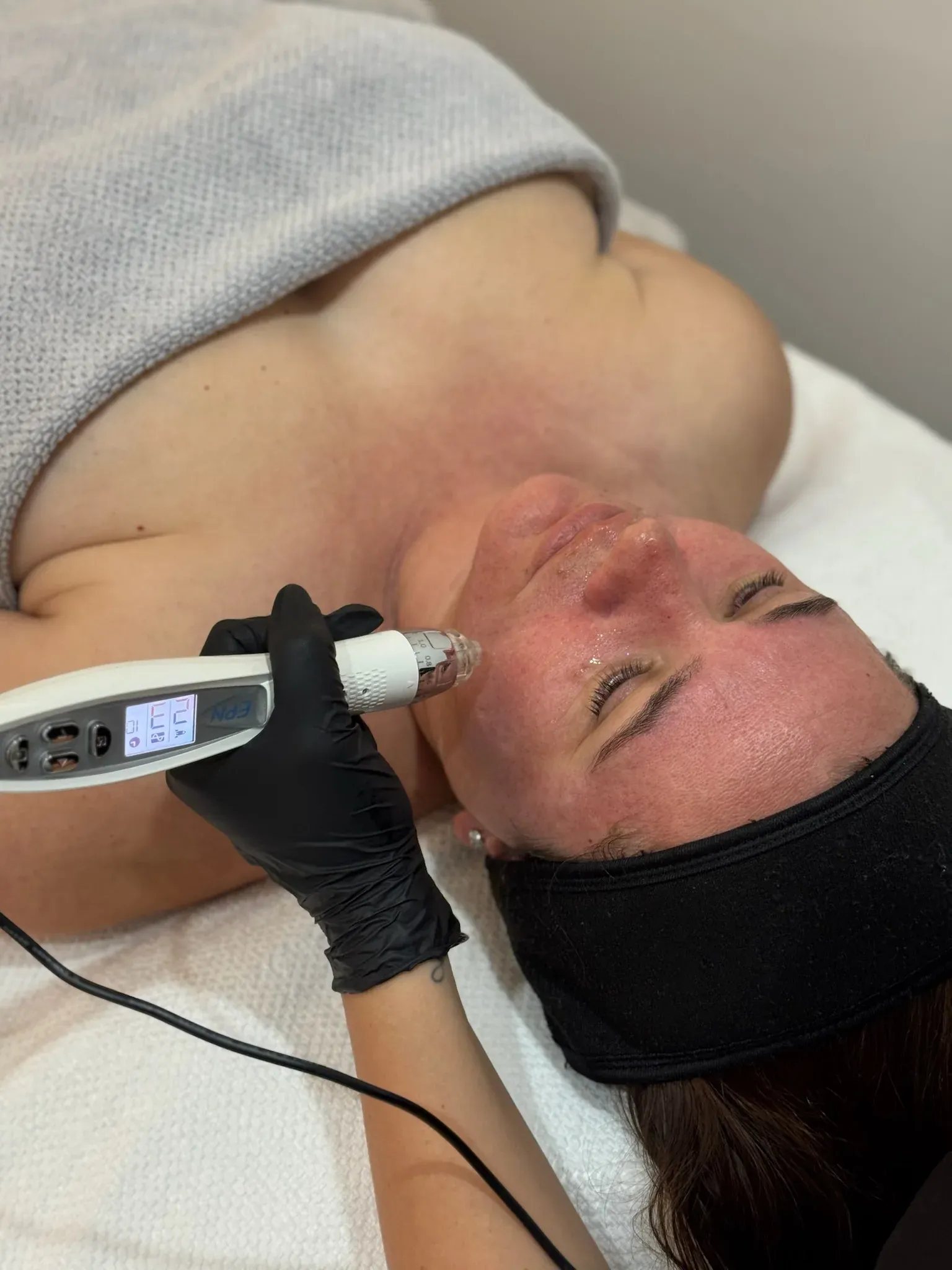 Skin Needling (Collagen Induction Therapy)