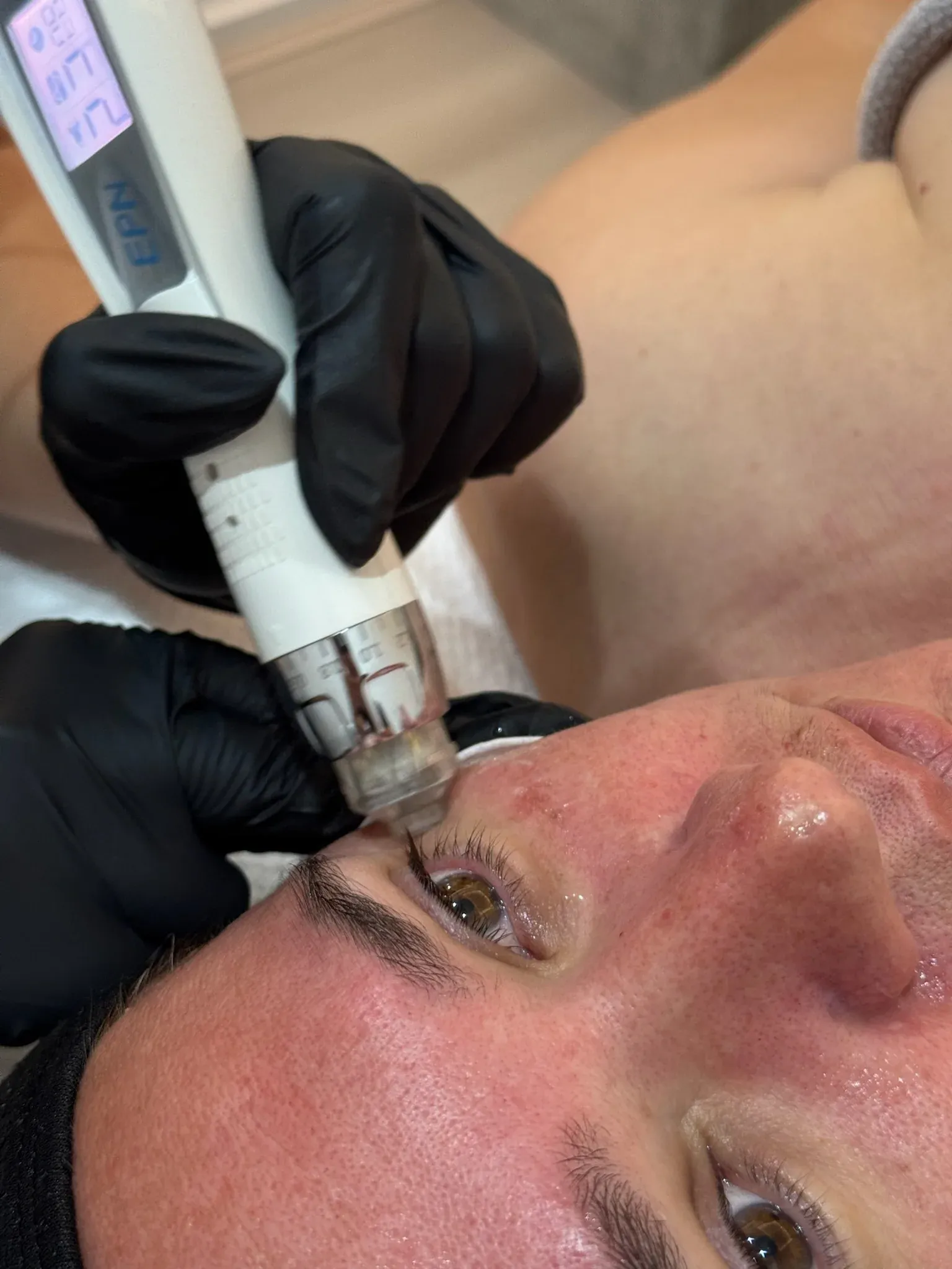 Skin Needling (Collagen Induction Therapy)