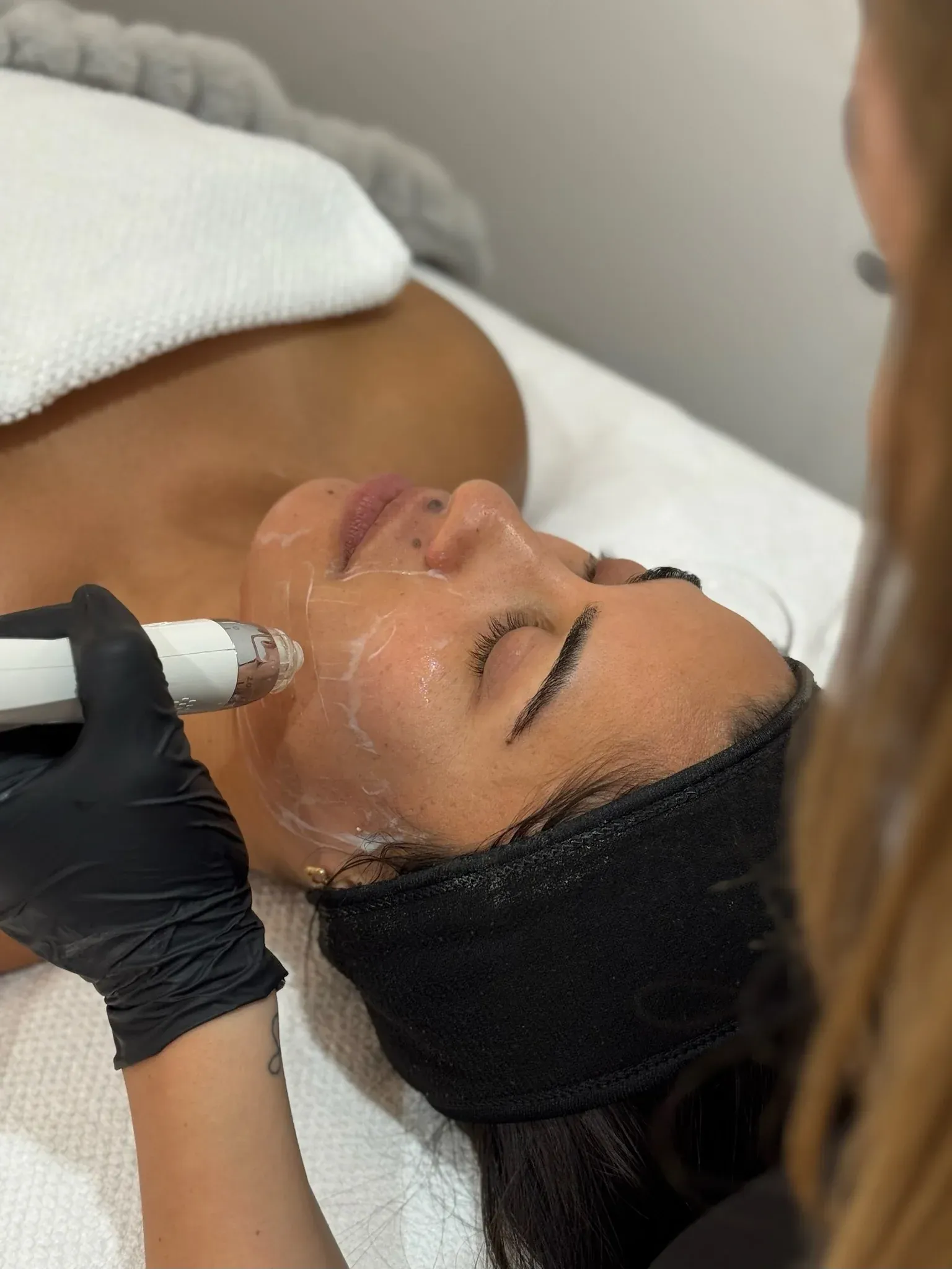 Skin Needling (Collagen Induction Therapy) — precision treatment