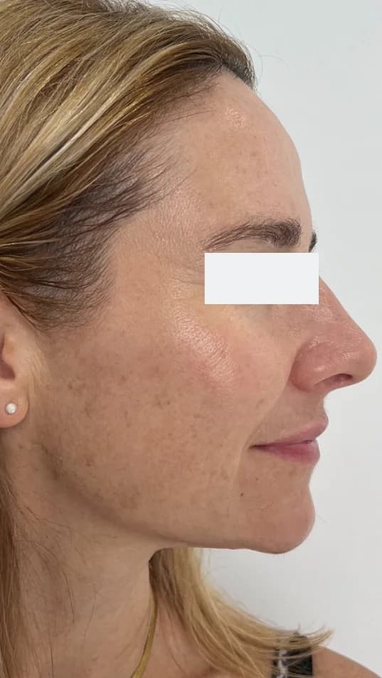 After — HIFU Full Face & Neck