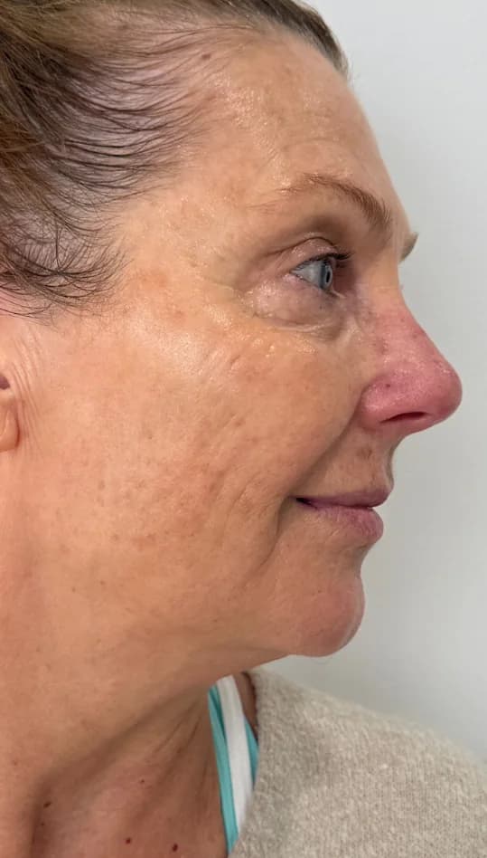 After — HIFU Full Face & Neck