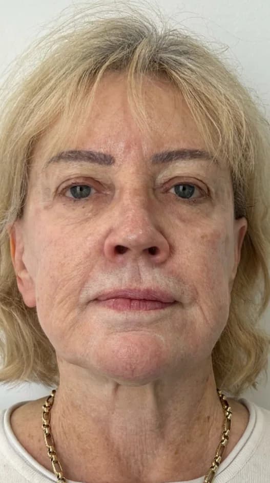 After — HIFU Full Face & Neck
