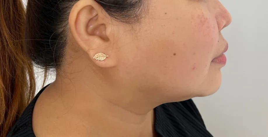 After — HIFU Full Face & Neck