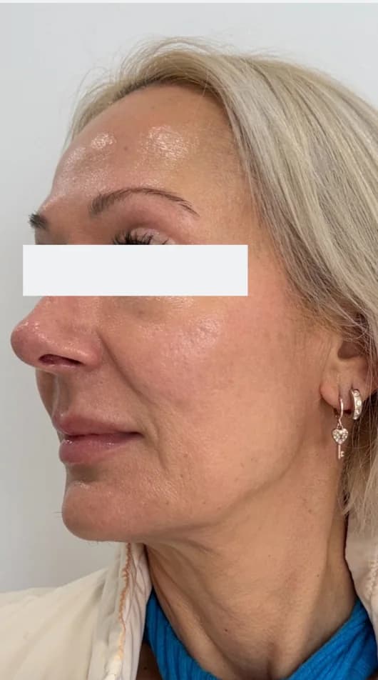 After — HIFU Full Face & Neck