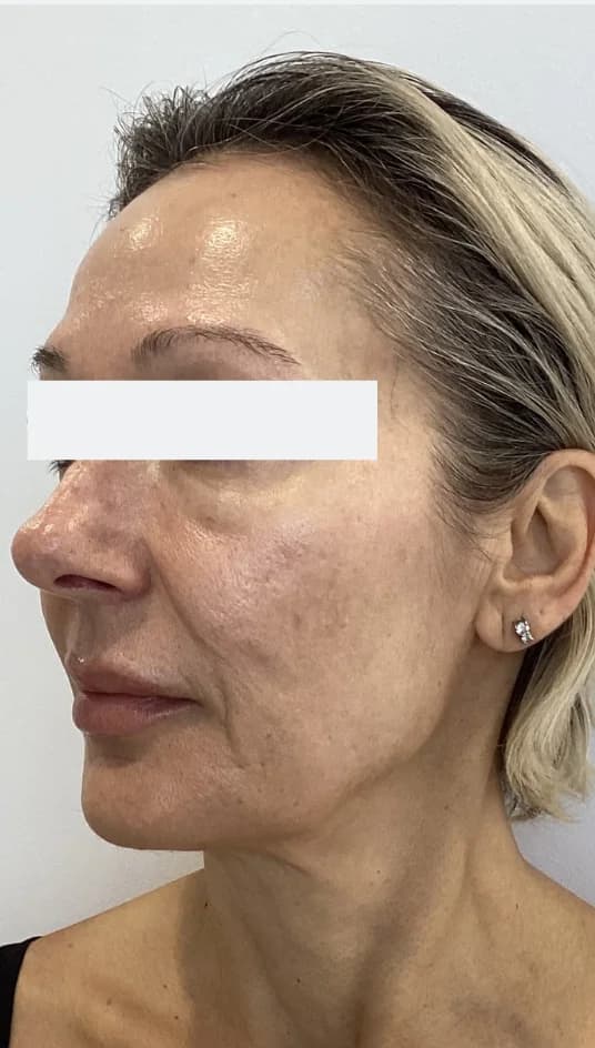 Before — HIFU Full Face & Neck