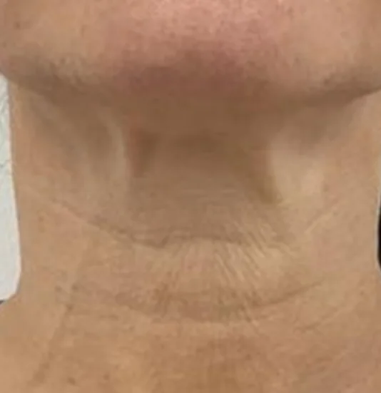 After — HIFU Full Face & Neck