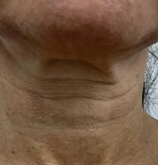 Before — HIFU Full Face & Neck