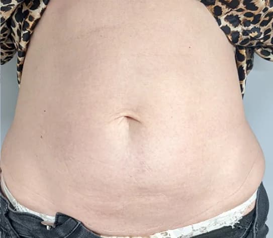 After — HIFU Full Abdomen