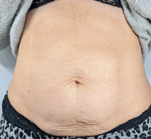 Before — HIFU Full Abdomen