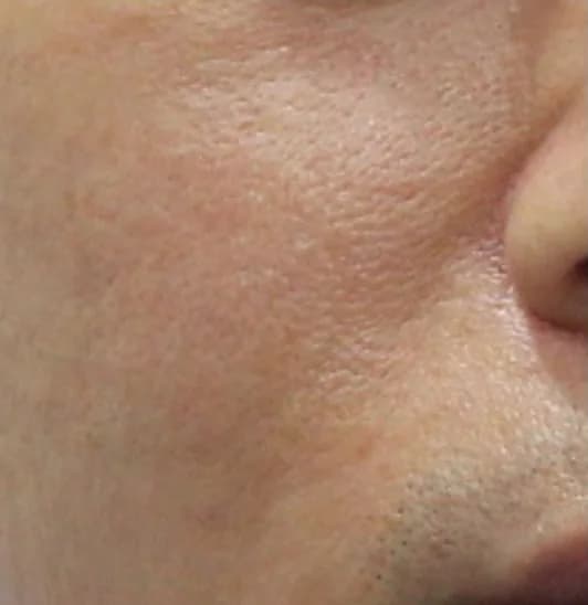 After — RF Microneedling