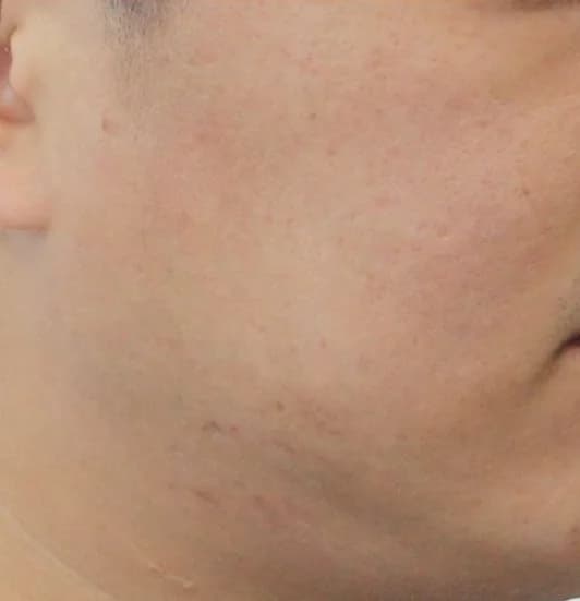 After — RF Microneedling