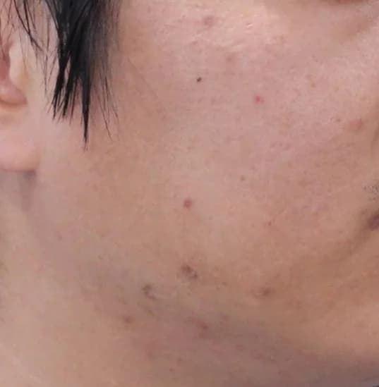 Before — RF Microneedling