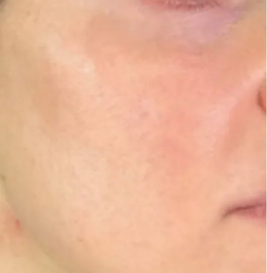 After — RF Microneedling + Exosomes