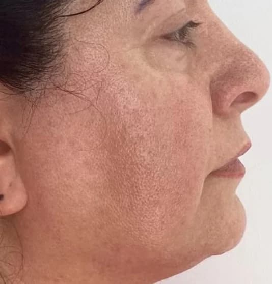 Before — RF Microneedling + Exosomes