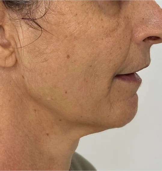After — HIFU Full Face & Neck