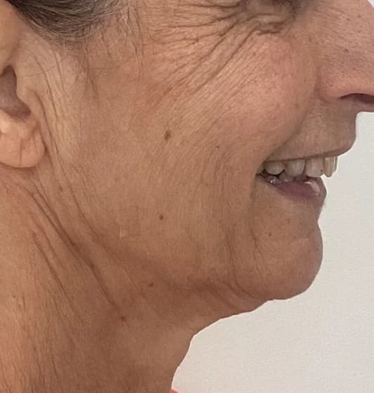 Before — HIFU Full Face & Neck