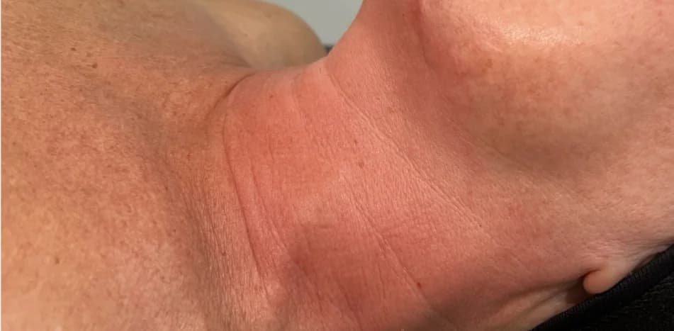 After — RF Microneedling + Exosomes