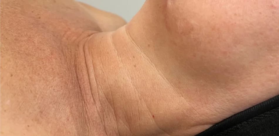 Before — RF Microneedling + Exosomes