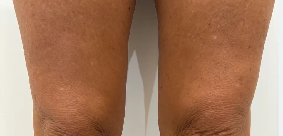 After — HIFU Knees