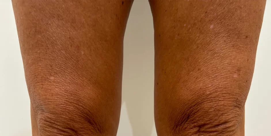 Before — HIFU Knees