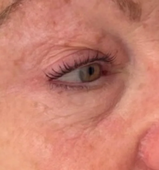After — HIFU Eyes